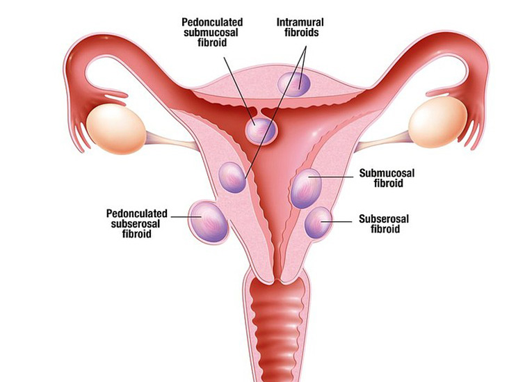 PCOS Treatment in PCMC