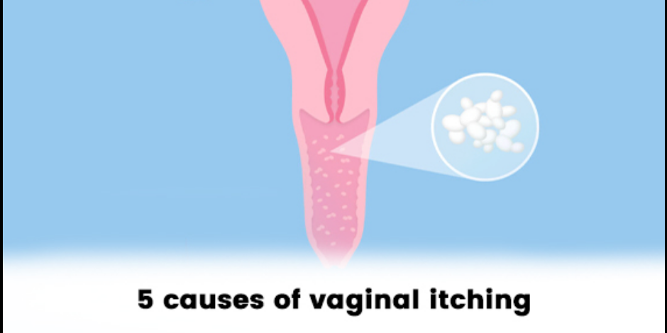 Top 5 Causes Of Vaginal Itching