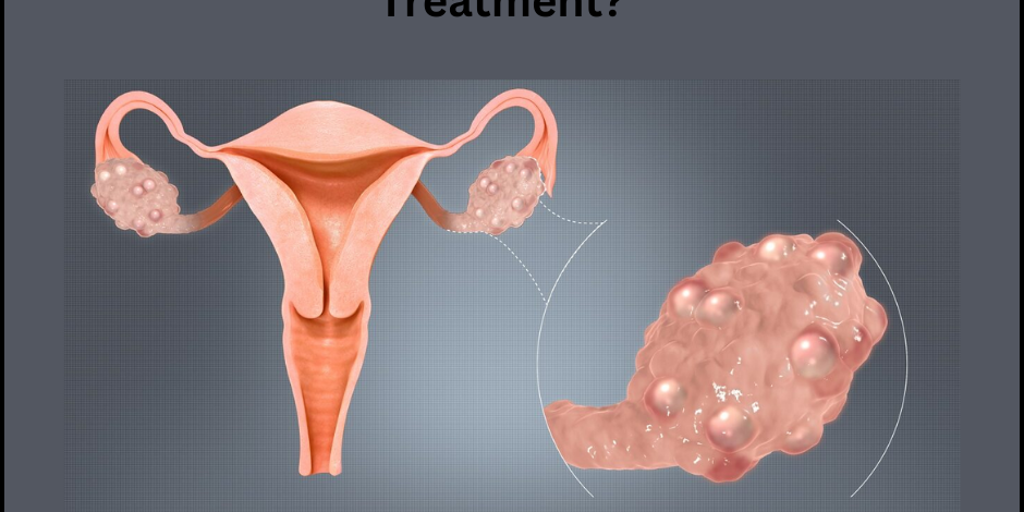What is PCOD, Cause, symptoms, and Treatment? PCOS Treatment in PCMC