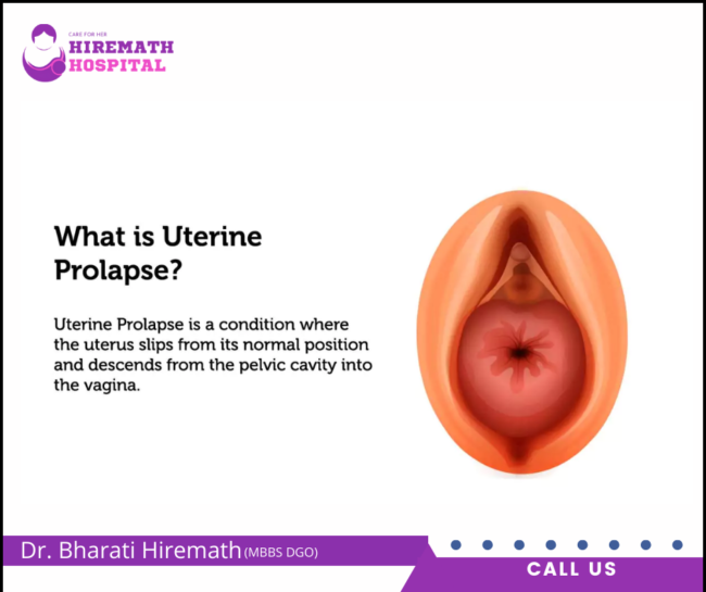 Uterine Prolapse: Causes, Symptoms, Treatment – Hiremath Hospital Uterine Prolapse in PCMC