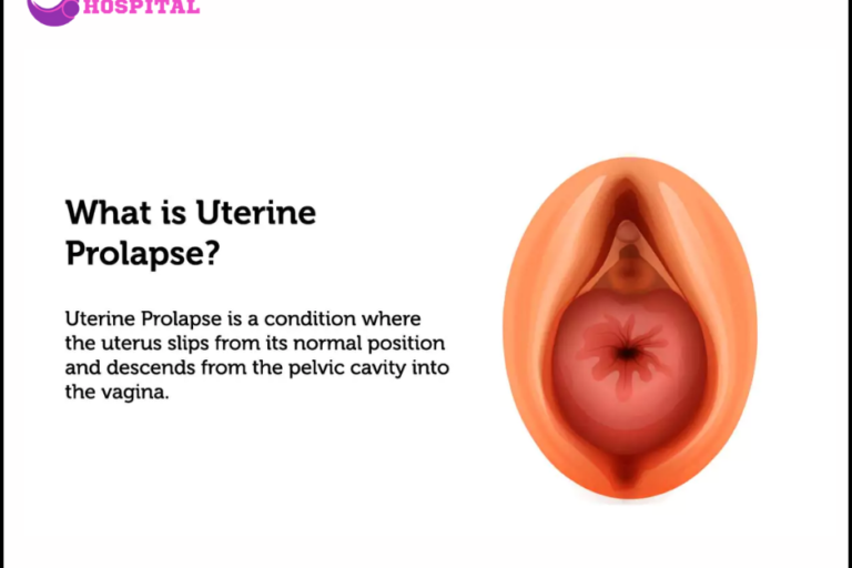 Uterine Prolapse: Causes, Symptoms, Treatment – Hiremath Hospital Uterine Prolapse in PCMC