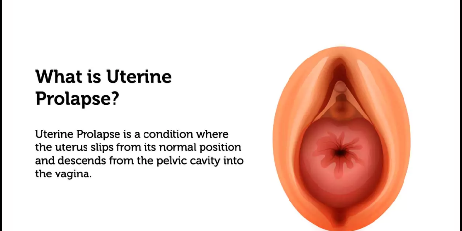 Uterine Prolapse: Causes, Symptoms, Treatment – Hiremath Hospital Uterine Prolapse in PCMC