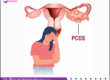 PCOS Treatment in PCMC