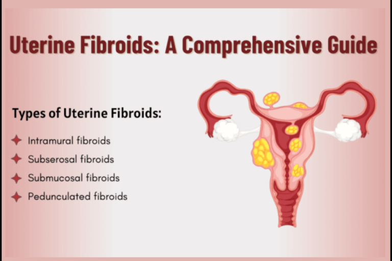Uterine Fibroids: Causes, Symptoms, Types, and Treatment Uterine Fibroids Treatmenet in PCMC