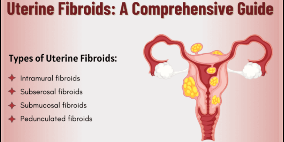 Uterine Fibroids: Causes, Symptoms, Types, and Treatment Uterine Fibroids Treatmenet in PCMC