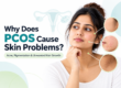 PCOS Skin Problems: Acne, Pigmentation & Facial Hair